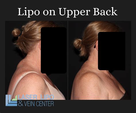 liposuction cost st louis|Liposuction in St. Louis, MO 